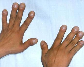 acromegaly acromegaly